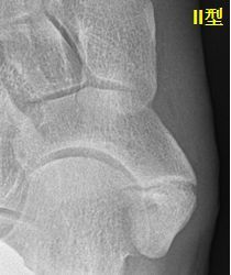 副足舟骨别忽略分型要牢牢记住