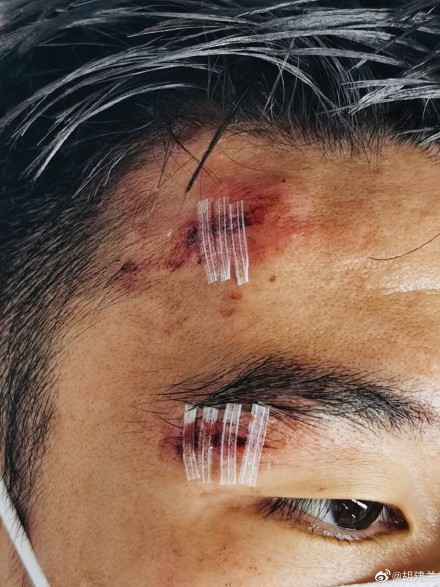 胡建关晒满头可怕伤痕:为祖国而战 伤痕都是勋章