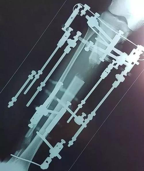 高三男子因身高矮小自卑,花16万断骨增高7.