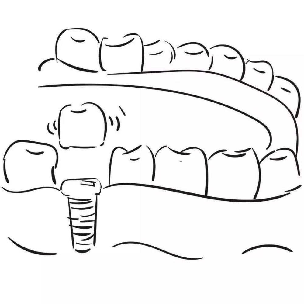 step 7,日常护理完成缺失牙种植后,就要像对待真牙一样护理种植牙:做