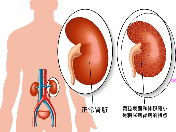 糖尿病患者就怕伤肾及早发现很重要预测糖尿病肾病风险扫码来测