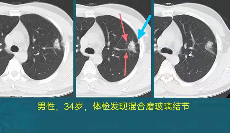 肺結節與肺癌怎麼區分醫生教你看ct認識3種惡性肺結節