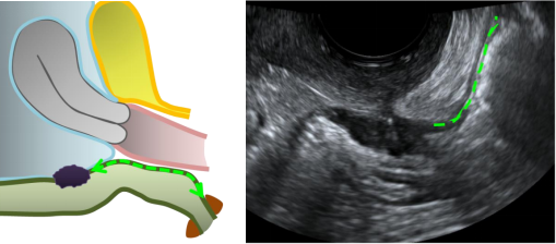 检查方法,当考虑存在严重类型的深部内异症病变或道格拉斯陷凹闭合时