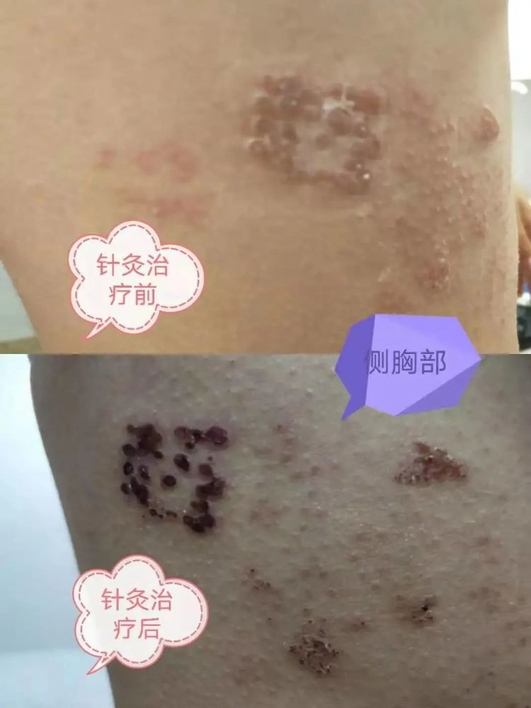 带状疱疹,还可针灸治疗?_腾讯新闻