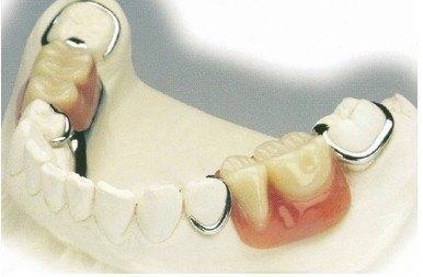 过去,牙齿缺失修复方法主要分两种:固定义齿和活动义齿.