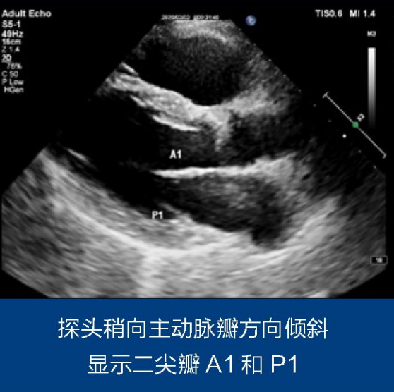 二尖瓣解剖分區及常用超聲掃查切面