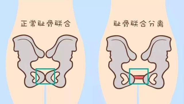 三,如何缓解耻骨疼痛1,凯格尔运动前面我们提到孕期孕妈妈体内会分泌