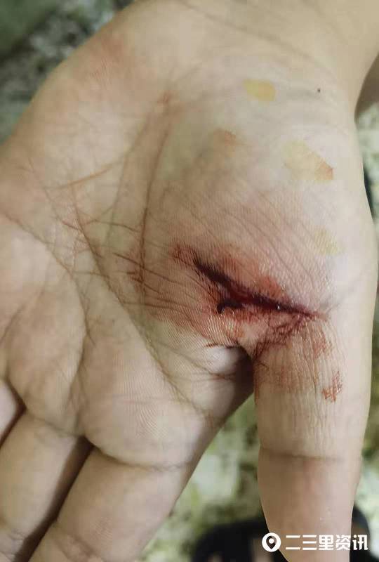 【小里帮忙】在嘉丰国际一游泳馆学习游泳,延安10岁男孩手部划破缝了7