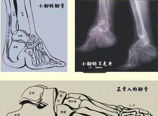 万恶的三寸金莲,谁是历史上缠足第一人?又是谁在提倡这恶习?