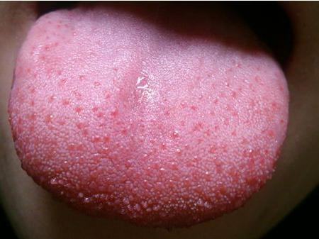 维生素b12|维生素|口腔溃疡|贫血|舌头|口腔异味