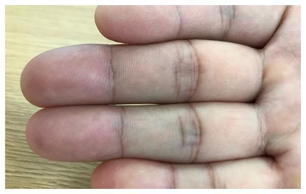 身体有癌四肢先知医生提醒出现3个表现尽快预约肿瘤科