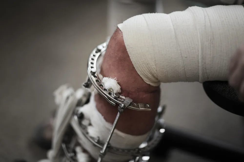 还挺合理,但这种方法可能引起非常严重的后果,包括因为支架固定不够