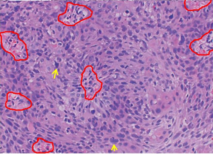 食管鳞癌(水平切面):红色圈内为乳头结构;黄色箭头见病理性核分裂象