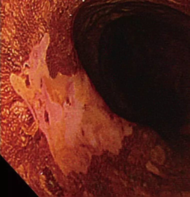 内镜色素的使用及配制方法与esd术后染色大全