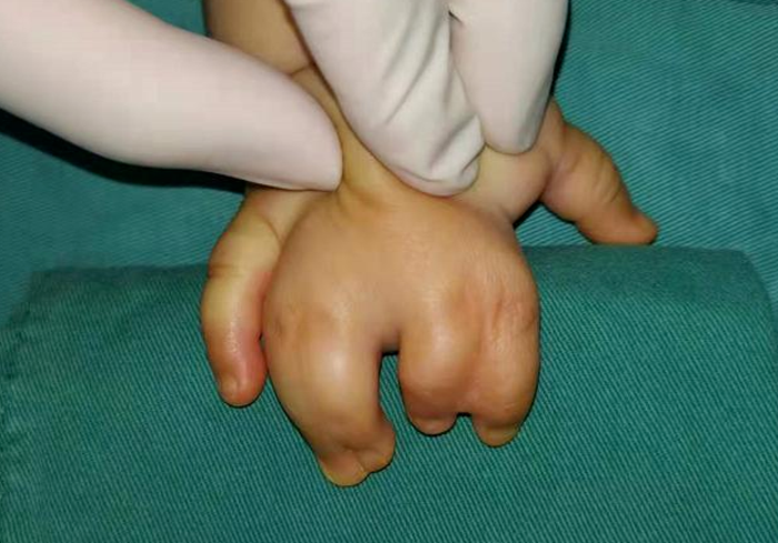 胎儿手部畸形多发生在孕期哪个阶段