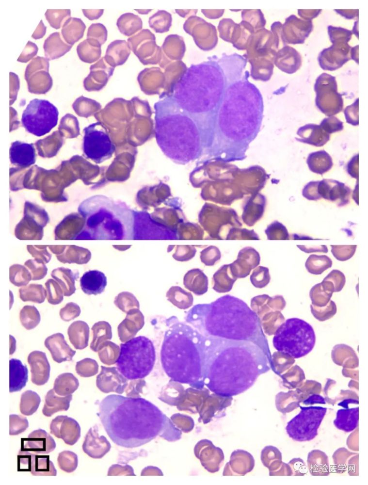一幅菊花爆满山的涂片揭示出凶险的神经母细胞瘤