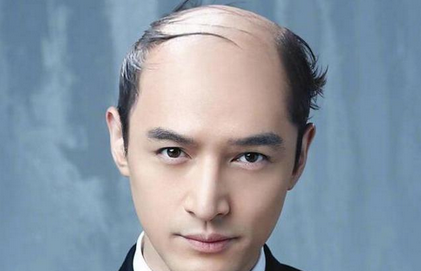 24岁帅小伙秃顶了内分泌科专家高血脂或会间接导致脱发