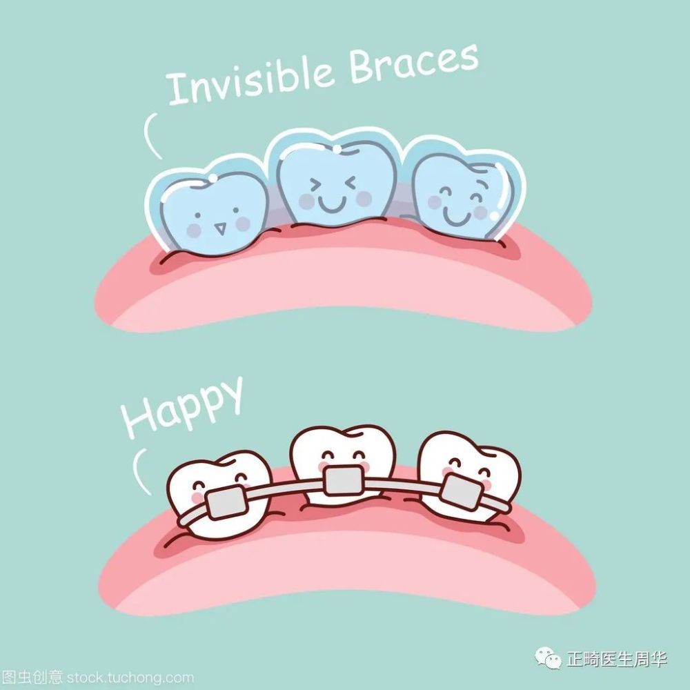 4,正畸矫治力过大,出现牙根与牙槽骨的吸收,致使牙齿出现松动,甚至