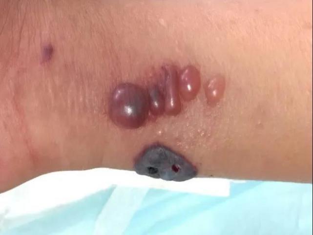 北京报告1例外地来京就诊肺炭疽病例已隔离治疗