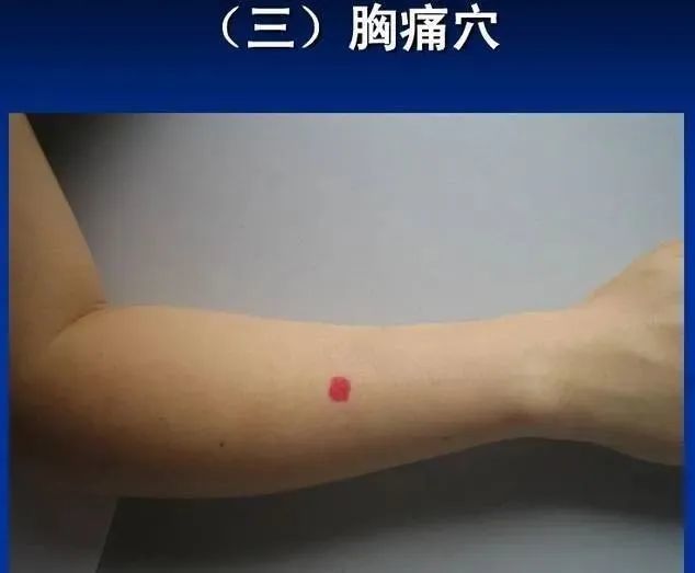 按:此为平衡针胸痛穴外关上一寸,同样是0.