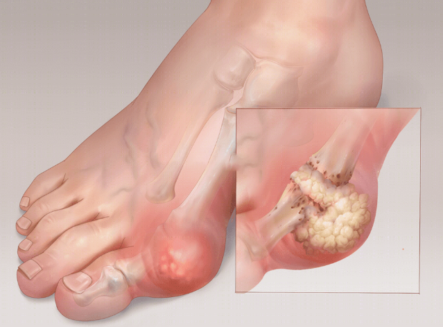 科普痛风性关节炎关节痛时不要吃降尿酸药物