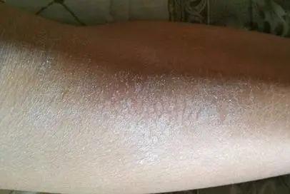 每次脱衣服腿上都有很多皮屑脱落医生提醒这种维生素该补了