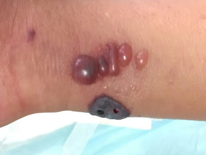 北京报告1例来京就诊肺炭疽病例,三种途径可感染,严重可致死