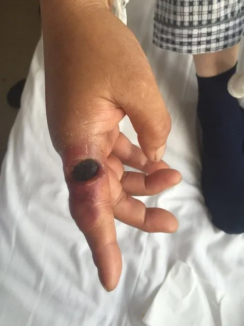 北京报告1例来京就诊肺炭疽病例,三种途径可感染,严重可致死