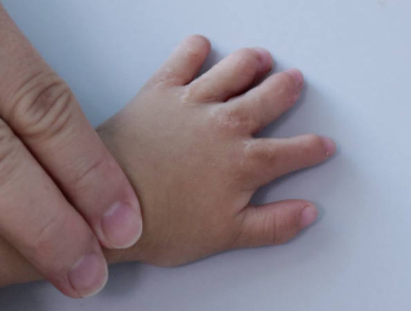 超过300种综合征伴有并指畸形,最常见的就是poland综合征(波兰综合征)