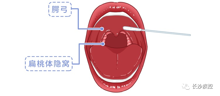 核酸采集咽部示意图图片