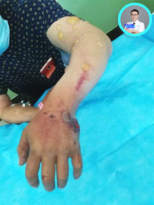 北京报告1例肺炭疽病例炭疽病汹涌来袭牛羊肉还能吃吗