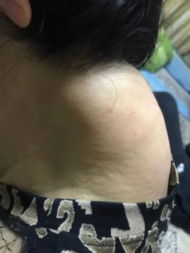 50岁女子时常头晕医生竟从她脖子后取出一颗如鸟蛋般大的瘤
