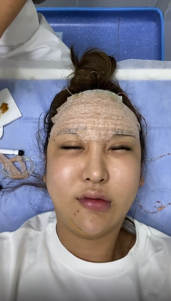 网红整容过度导致额头溃烂,头裹纱布场面恐怖,却仍不放弃继续整_腾讯