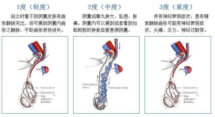 精索静脉曲的介入治疗