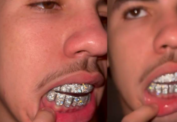 rapper钻石牙套图片