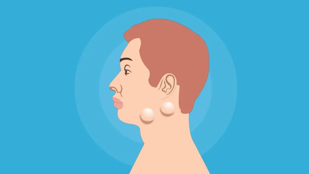 淋巴结是什么东西(淋巴结是什么东西引起的)