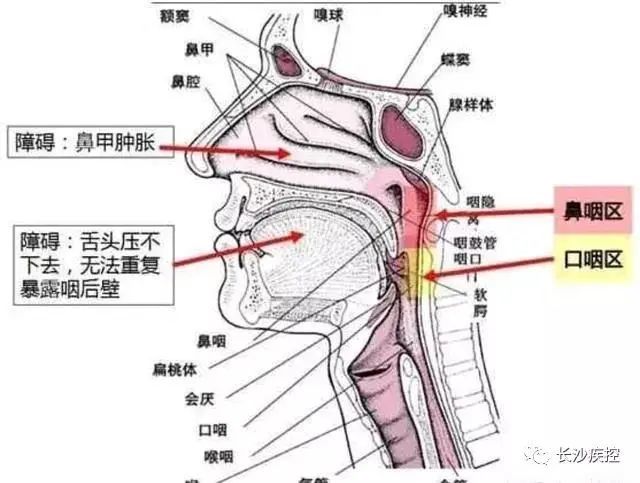 采核酸咽喉部准确部位图片