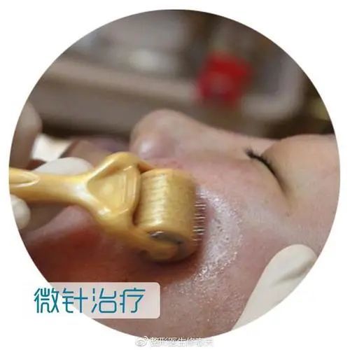 微针美容属医疗美容非医疗机构不得开展一文说清微针疗法