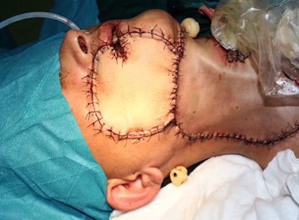 槟榔手术割脸图片