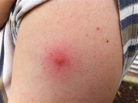 只有1例发病也要上报当年美国炭疽事件可是生物恐怖袭击