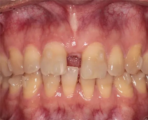 门牙多生牙做正雅隐形矫正没想到在深圳正恩口腔12个月就矫正成功了