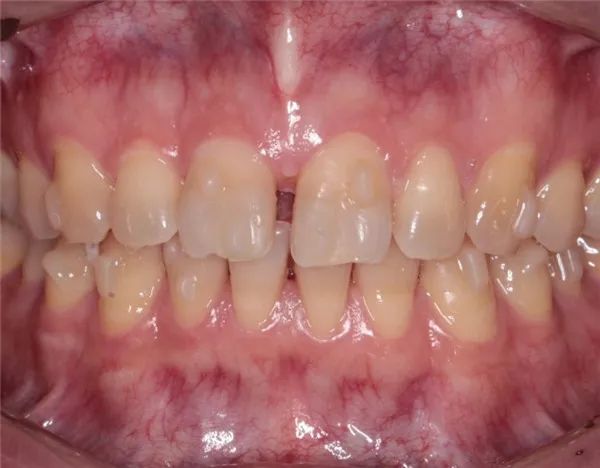 门牙多生牙做正雅隐形矫正没想到在深圳正恩口腔12个月就矫正成功了