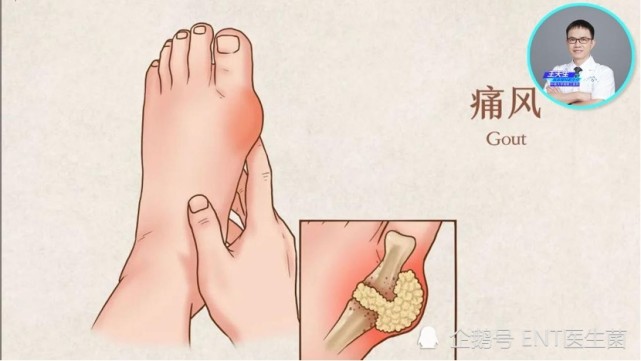饮食不节制19岁学生遍布痛风石医生教你六种痛风的规范化治疗