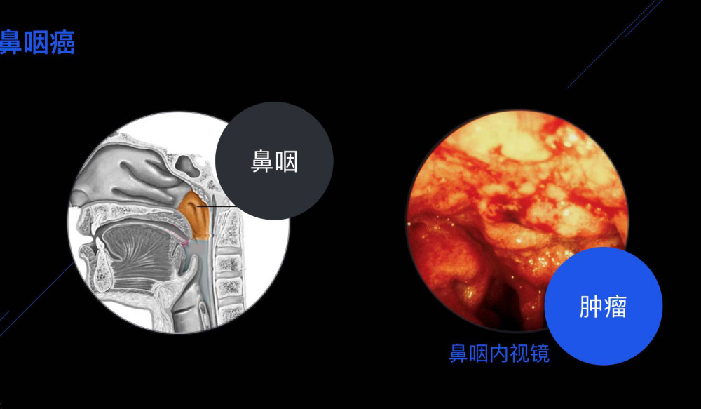 37岁男子鼻涕中带血,误以为是上火,医院一查诊断为鼻咽癌_腾讯新闻