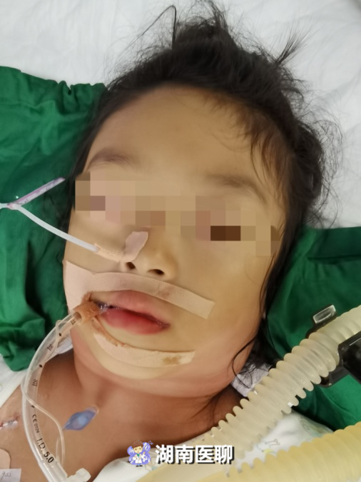 家长注意女童发烧发成大脖子检查竟是化脓性淋巴结炎