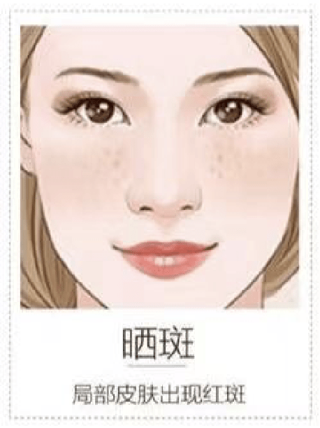 日光斑:紫外线照射引起,又称晒斑.黑褐色,芝麻至硬币大小.