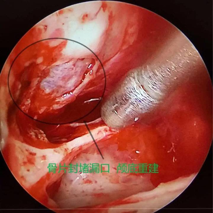 流鼻涕一个多月竟是脑脊液鼻内镜下脑脊液修补术解难题