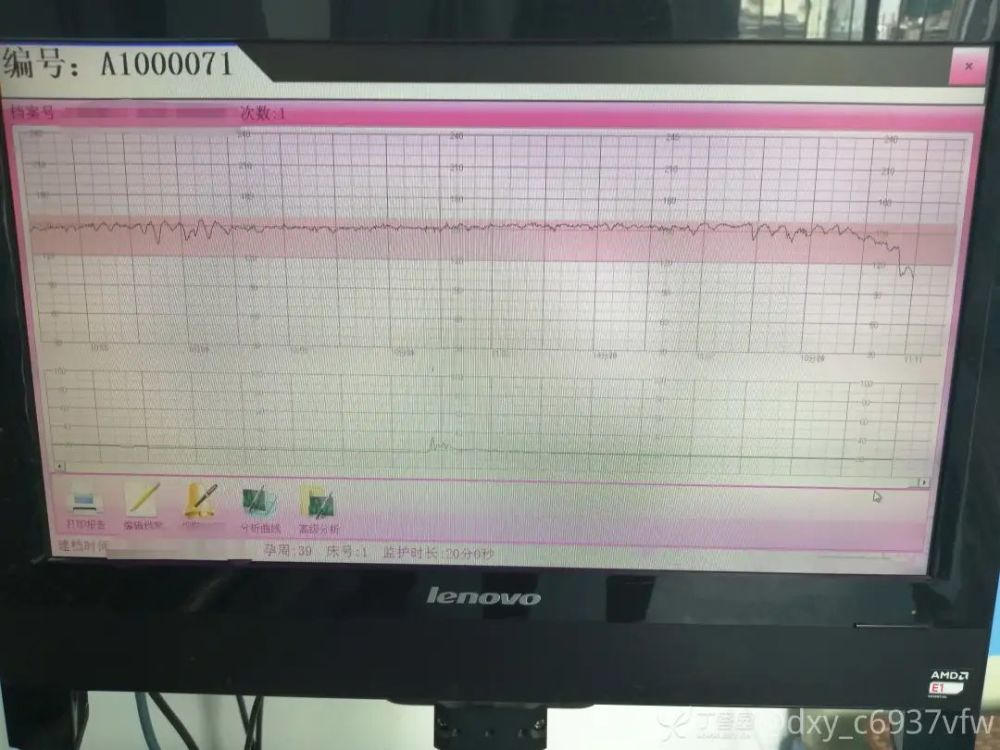 诊疗经过:入院后行胎心监护:基线约 150 bpm,微小变异,存在自发减速