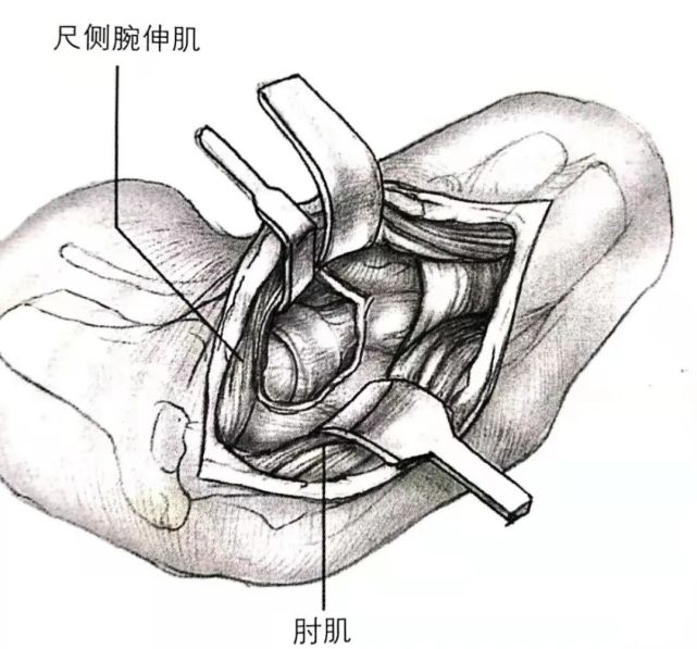 神經,注意前臂旋前如何使後骨間神經遠離手術野c:切開肱橈關節關節囊