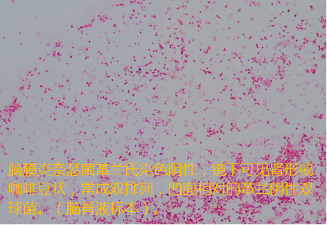 脑膜炎奈瑟菌染色与形态该菌是一种革兰阴性双球菌,属于兼性胞内菌,无